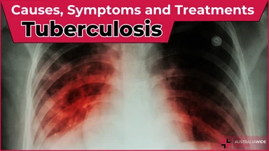 Tuberculosis article header – First Aid Article in Beaudesert